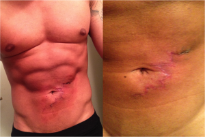 1-week after Purity Bridge tattoo removal