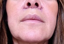 6-purity-bridge-lip-lift-stitches-out