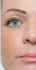 After TCA peel 2