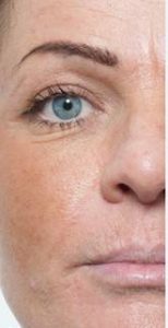 Before TCA peel 2