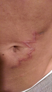 4-weeks after Purity Bridge scar removal