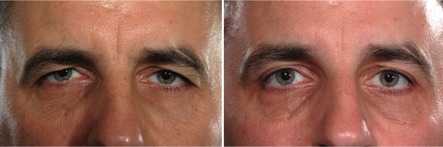Feeling worn down this Father’s Day? How about some “Brotox” to freshen your appearance?