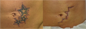 Purity Bridge plastic surgery markings for tatto removal and immediately following surgery