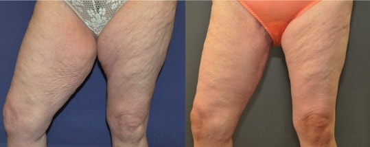 Banishing thunder thighs – how hard is it to do?