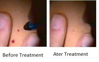 Facial Thread Vein Treatment