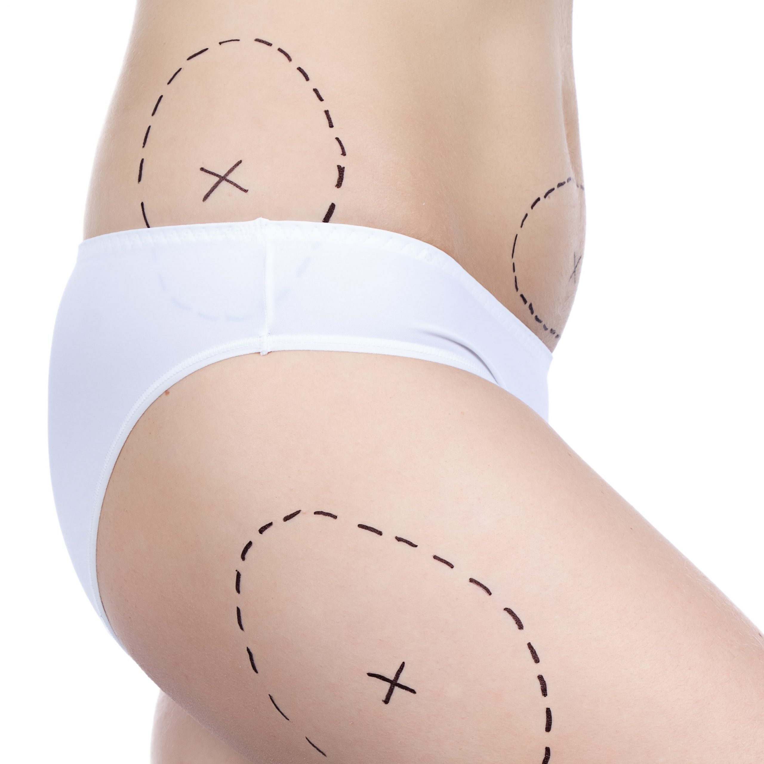 Liposuction loves Love-handles …wide awake!