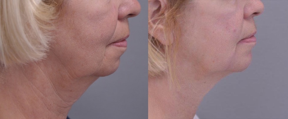 The Purity Bridge Facial Contouring Package