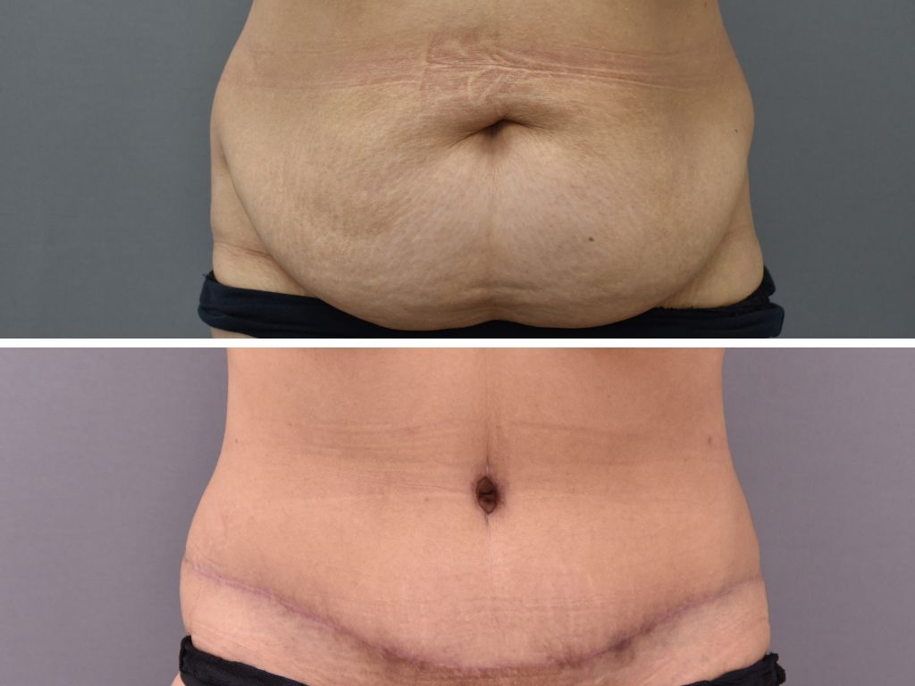 about tummy tuck surgery